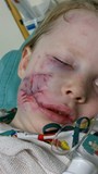 Alex after surgery