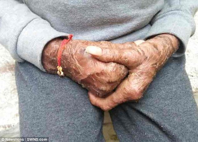 El impactante caso de la “Niña Serpiente” de la India que cambia de piel cada 45 días - Imagen 7