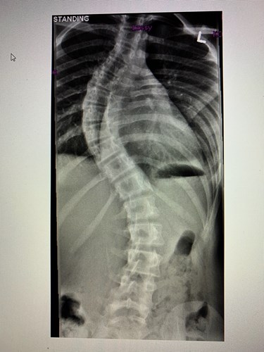 scoliosis surgery spine daughter private justgiving tilly template fund clearly shape