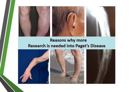 The National Association For The Relief Of Paget's Disease - JustGiving