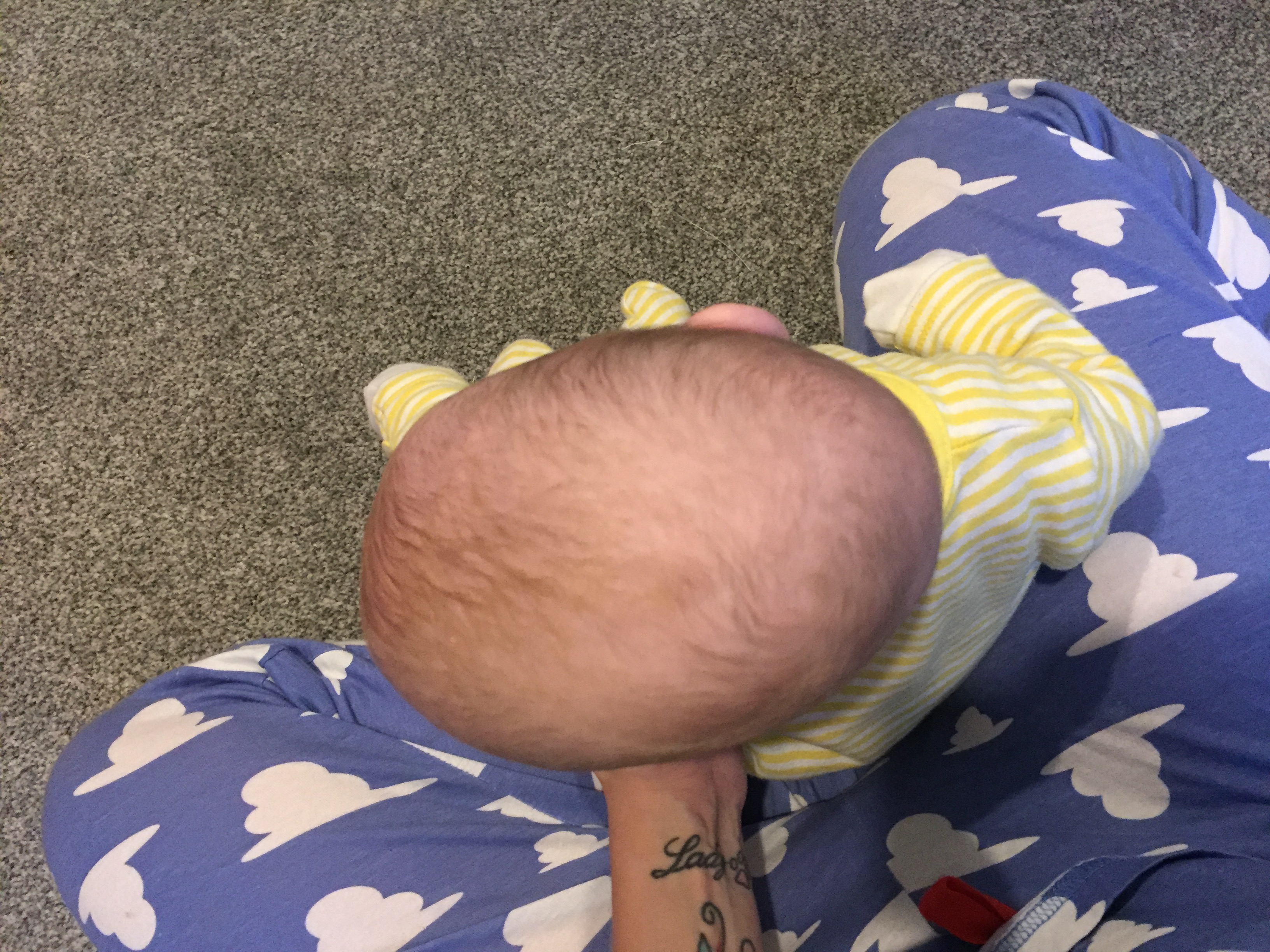 flat head syndrome nhs