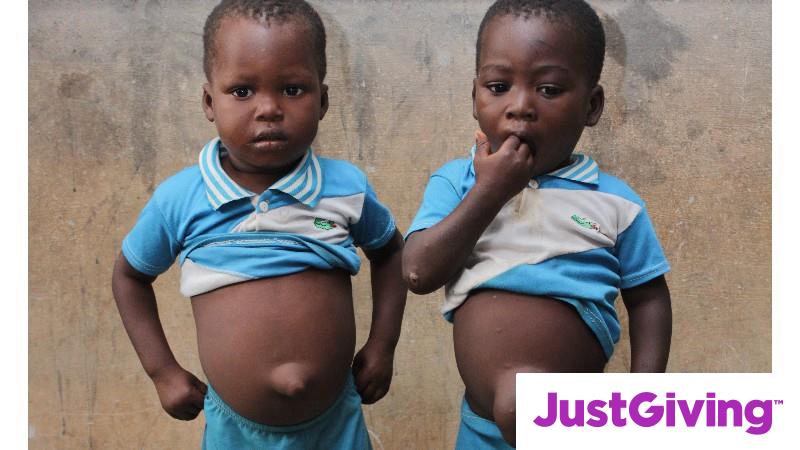 Crowdfunding to fund surgery and aftercare to remove 5 kids umbilical ...