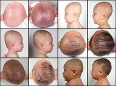 helmet therapy plagiocephaly